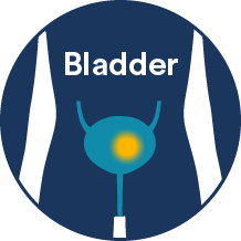 bladder cancer