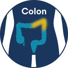 colon cancer