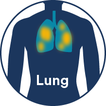 lung cancer